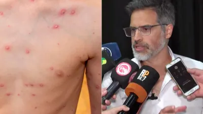 Garcilazo conferencia de prensa varicela